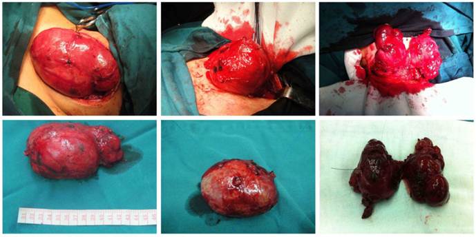 The picture shows the patient has undergone a goiter surgery. The doctor has taken out a giant nodular goiter from the patient&rsquo;s neck. 